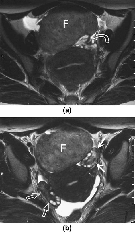 References In Mri Features Of Ovarian Fibromas Emphasis On Their