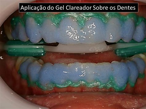 Como Clarear Os Dentes Aplica O Do Gel Clareador Em Gel