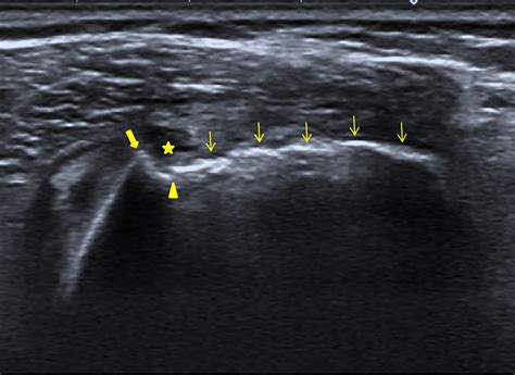 Ultrasonography In The Diagnosis Of Rotator Cuff Avulsion Fracture Tang 2022 Journal Of