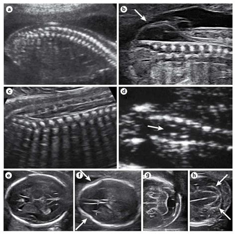 Spina Bifida Ultrasound 13 Weeks