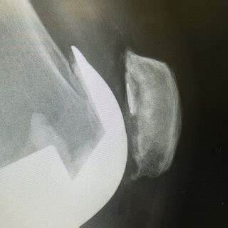 Patella Loosening On Preoperative Radiographs Of A Year Old Male