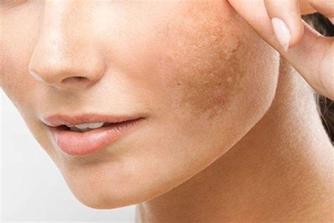 Laser Acroma Tratamento De Melasma Para Todos Os Tons De Pele