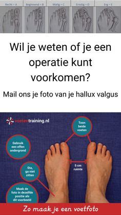 Hallux Valgus