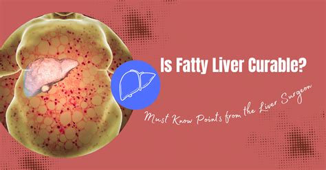 Is Fatty Liver Curable Understanding The Risks Symptoms And Treatment