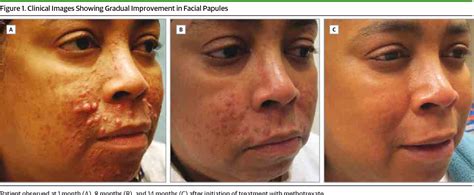 Figure 1 From Cutaneous Rosai Dorfman Disease Successfully Treated With