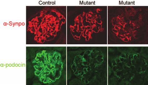 Synaptopodin And Podocin Expressions Both Were Downregulated In