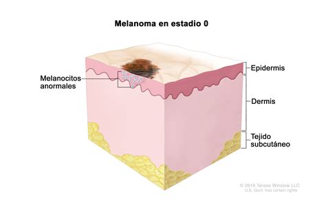 Tratamiento Del Melanoma Nci