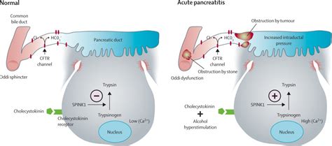 Acute Pancreatitis The Lancet