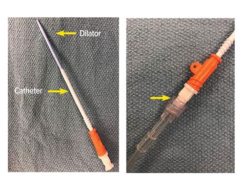 Perils And Pitfalls With The Rapid Infusion Catheter Ric Anesthesia