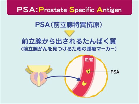 前立腺がんの検査 いまもと泌尿器科クリニック