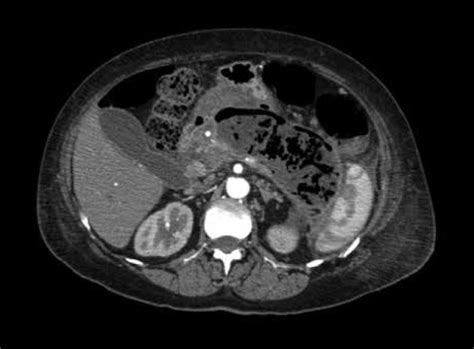 Walled Off Pancreatic Necrosis