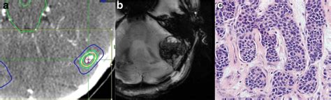 An Enlarging Hemorrhagic Mass Following Stereotactic Radiosurgery And