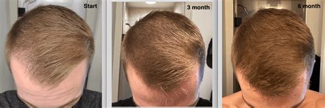 6 Month Finasteride Minoxidil Growth Positive Results R Tressless