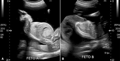 Ultrasound Showing Comparative Images In The Sagittal Plane Of A Download Scientific Diagram