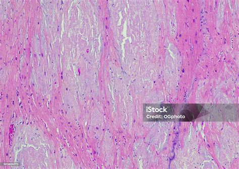 Cardiac Amyloidosis Stock Photo - Download Image Now - Heart - Internal ...