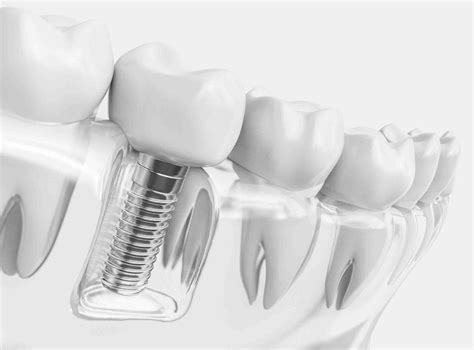 How Painful Is Dental Implants Dental News Network