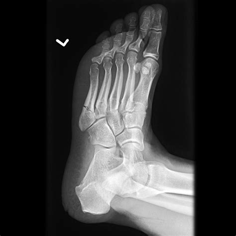 Jones Fracture Image Radiopaedia Org