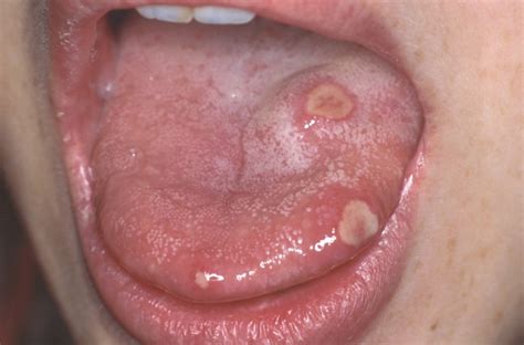 Mouth Ulcers Aphthous Stomatitis Ralev Dental Clinic