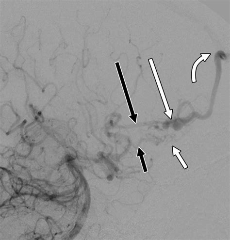 Contemporary Imaging Of Cerebral Arteriovenous Malformations Ajr