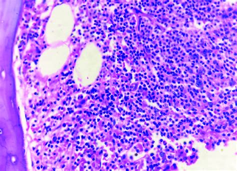 Bone Marrow Biopsy Showing Hypercellular Marrow With Diffuse