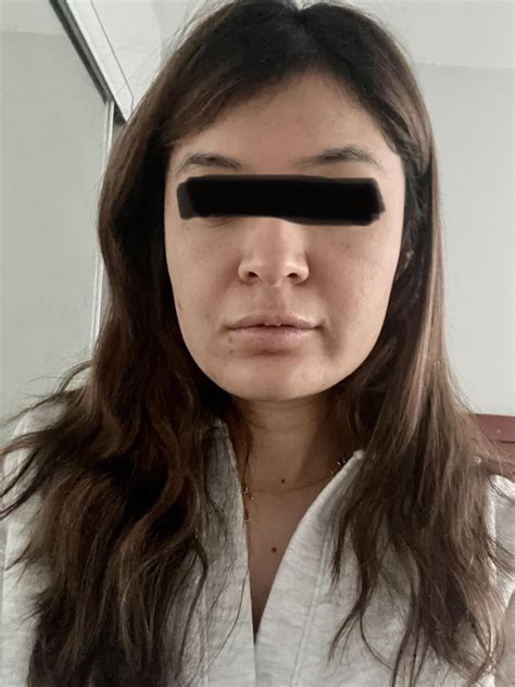 Any Procedures To Help With Square Uneven Jawline Nose Facial Symmetry And Hollow Mid Face