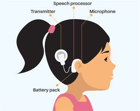 Deaf Culture And Cochlear Implants