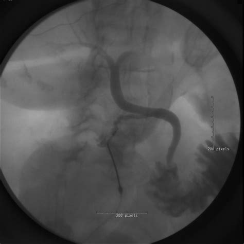 Gallbladder Torsion With Acute Cholecystitis And Gross Necrosis Bmj Case Reports