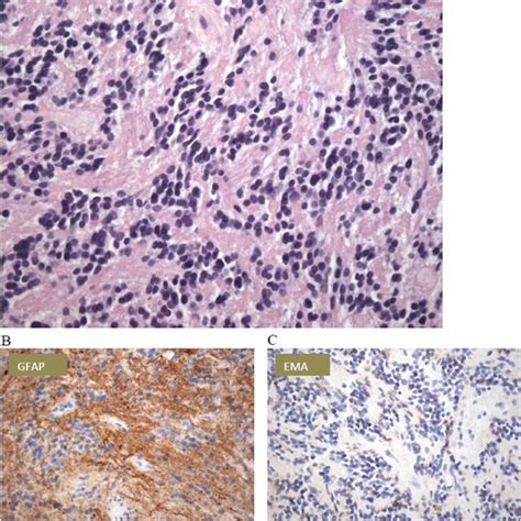 Histology Hematoxylin Eosin Stain Appearance Of Low Grade