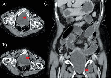 Figure 1 From Obturator Hernia A Rare Cause Of Acute Small Bowel