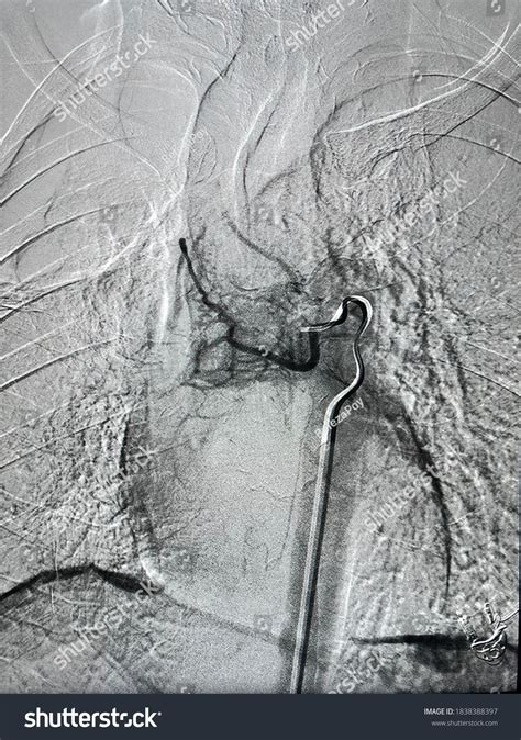 Pulmonary Angiogram During Bronchial Arteries Embolization Stock Photo