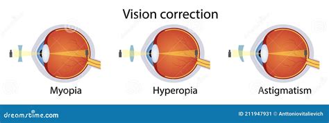 Correction Of Various Eye Vision Disorders By Lens Hyperopia Myopia Astigmatism Vector