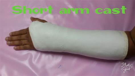 Application Short Arm Cast By Rake Krittanai Youtube