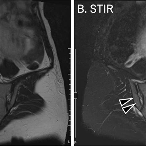 Magnetic Resonance Imaging Scans Of The Sacroiliac Joints Of The Download Scientific Diagram