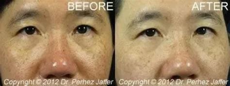 Ipl Photofacial Before And After Pictures Case 6 Vancouver Burnaby