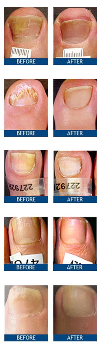 Toenail Fungus Laser Treatment Results - Before & After Photos