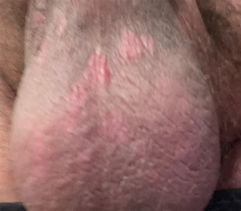 Itchy Scaley Skin On Scrotum R Diagnoseme