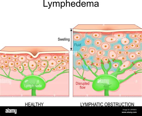 Lymphedema Cross Section Of A Human Skin With Healthy Lymphatic Vessel