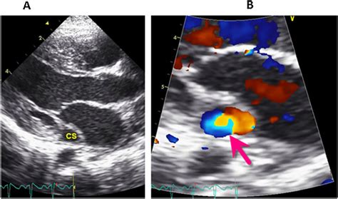 A Parasternal Long Axis View Showing A Dilated Coronary Sinus Cs