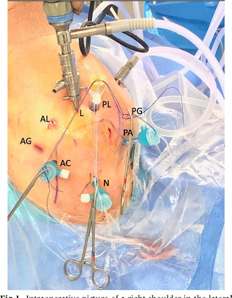 Arthroscopic Superior Capsular Reconstruction Using Hamstring Allograft