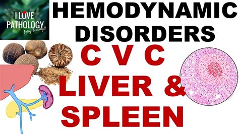 CVC Liver Spleen Pathogenesis Gross Microscopy YouTube