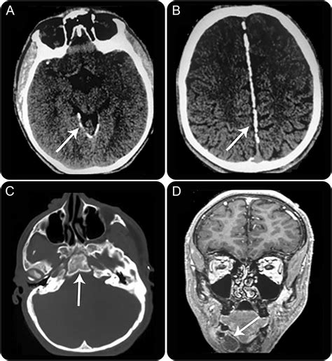 Teaching Neuroimages Clinical And Neuroimaging Features In Gorlin Goltz Syndrome Neurology