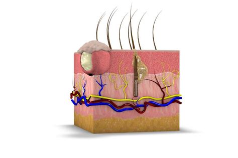 Section Of Skin With Cyst Subcutaneous Swelling Pilar Cyst And