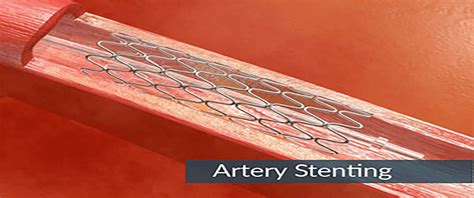 Benefits of Endovascular Repair with a Stent Graft | Dr.Abhilash