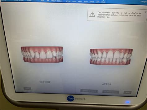 Severe Overbite Issue Anyone Having Similar Experience With Invisalign Particularly How Long