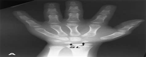 Normal Ranges Of Scapholunate Distance In Children 6 To 14 Y