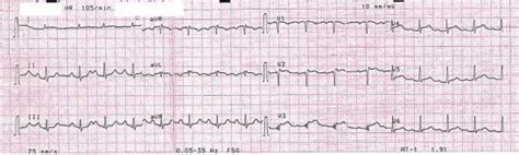 The Patients Ecg Shows St T Segment Elevation In Lead I Avl And V V