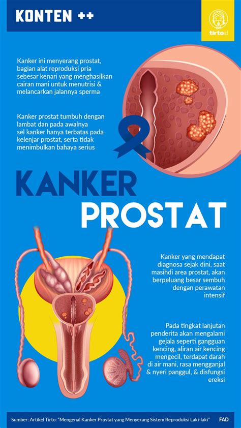 Mengenal Kanker Prostat Penyebab Gejala Hingga Pengobatannya Arus Baik