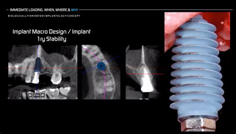 IMMEDIATE LOADING WHEN HOW AND WHY PART 2 Dentalsurgerychannel