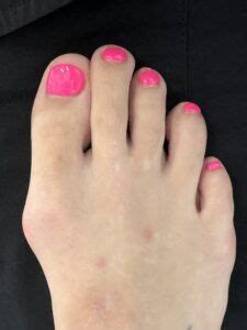 Bunion Before And After Photos Northwest Surgery Center