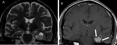 A MRI of a ganglioglioma in a 45-year-old man with refractory left ...